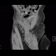 Repair of inguinal hernia, hematoma, mimic of recurrence: CT - Computed tomography